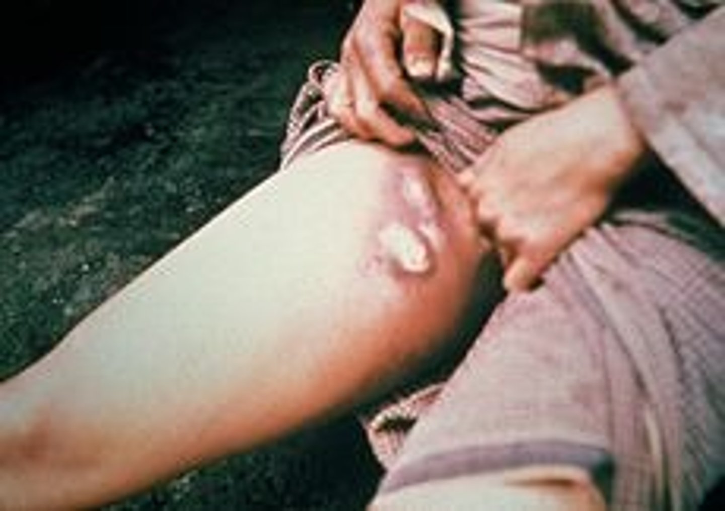 <p>Huge blisters, full of puss, that formed around the glands of the infected people (armpits, crotch, under neck and elsewhere)</p>