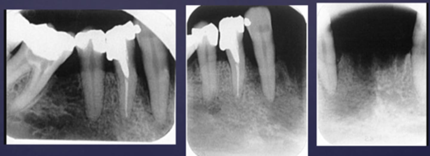 <p>What phase of osteomyelitis?</p><p>- Decrease in density of bone, loss of sharpness of trabeculae</p><p>- Localized or scattered regions of radiolucency, ill defined periphery</p>