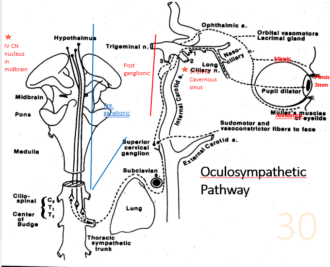 <p>Horners syndrome </p>