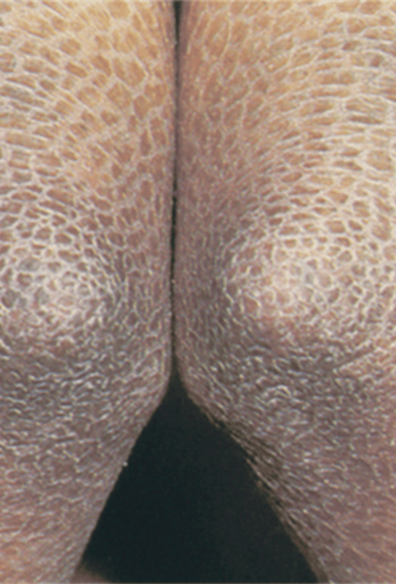 <p>_______________:</p><p>• Abnormal areas of stratum corneum</p><p>•An increased rate of epidermal cell proliferation</p><p>•May be adherent or loose, large sheet-like areas or tiny particles</p>