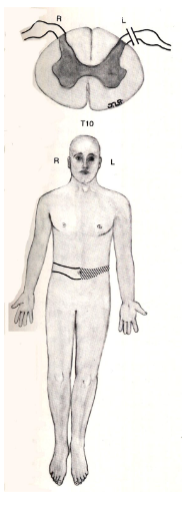 <ul><li><p>information from DRG can’t enter the cord</p></li><li><p>all sensory information from left side blocked </p></li><li><p>suspended sensory loss of both dorsal column and spinothalamic pathway</p></li></ul><p></p>