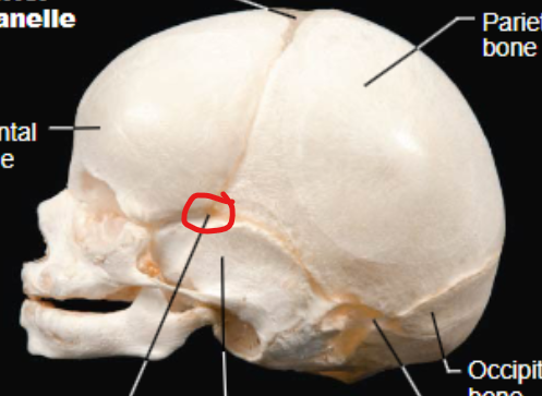 <p>Located on each side of the skull between the frontal, parietal, sphenoid, and temporal bones. It also closes shortly after birth.</p>
