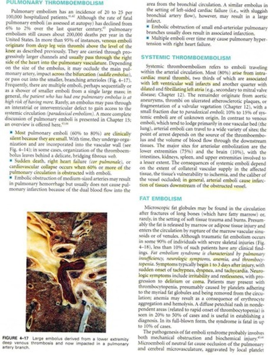 <p>Obstruction of pulmonary arteries by emboli.</p>