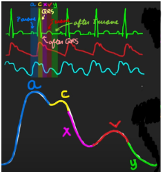 <p>Right Atrium Pressure</p>