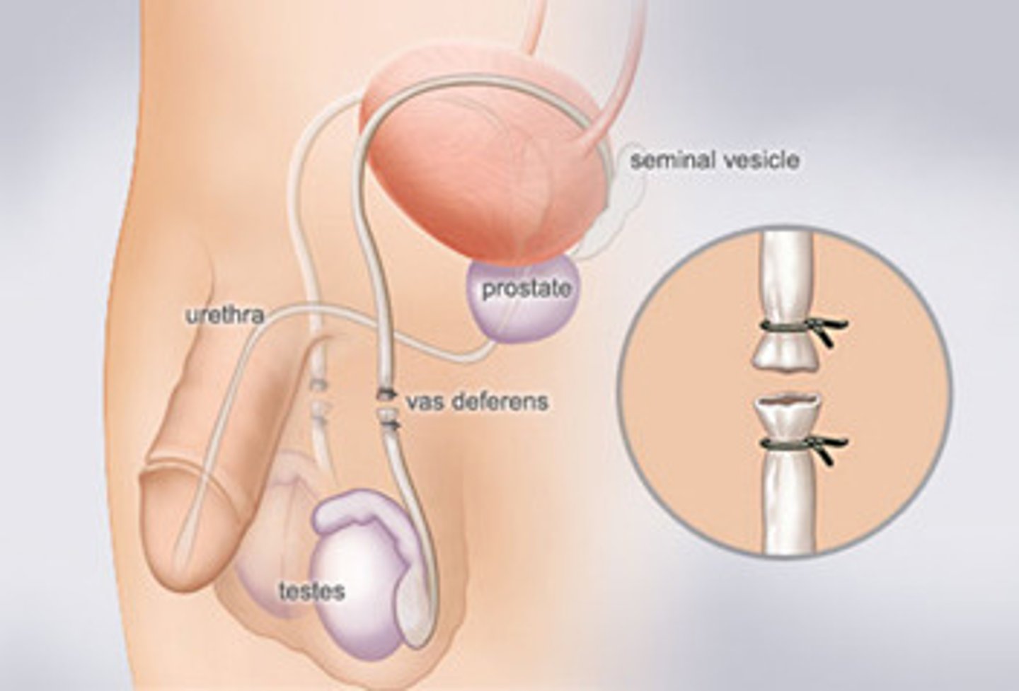 <p>vasectomy and female sterilisation</p>