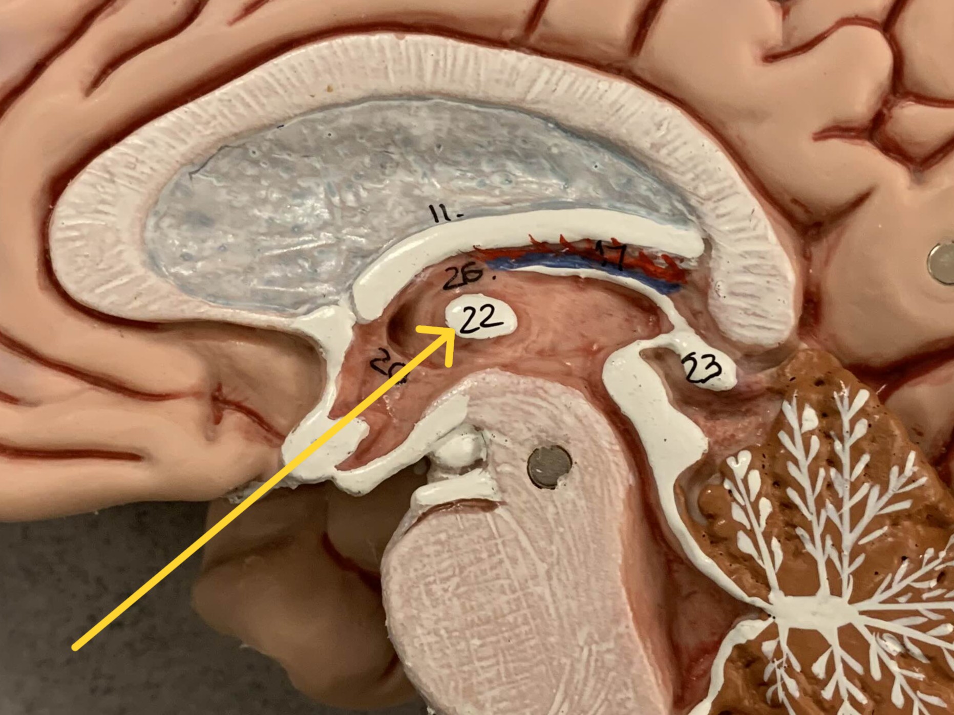 <p>Which part of the brain is:</p><ul><li><p>White dot on thalamus body</p></li><li><p>Center and crossing midline of third ventricle</p></li></ul><p></p>