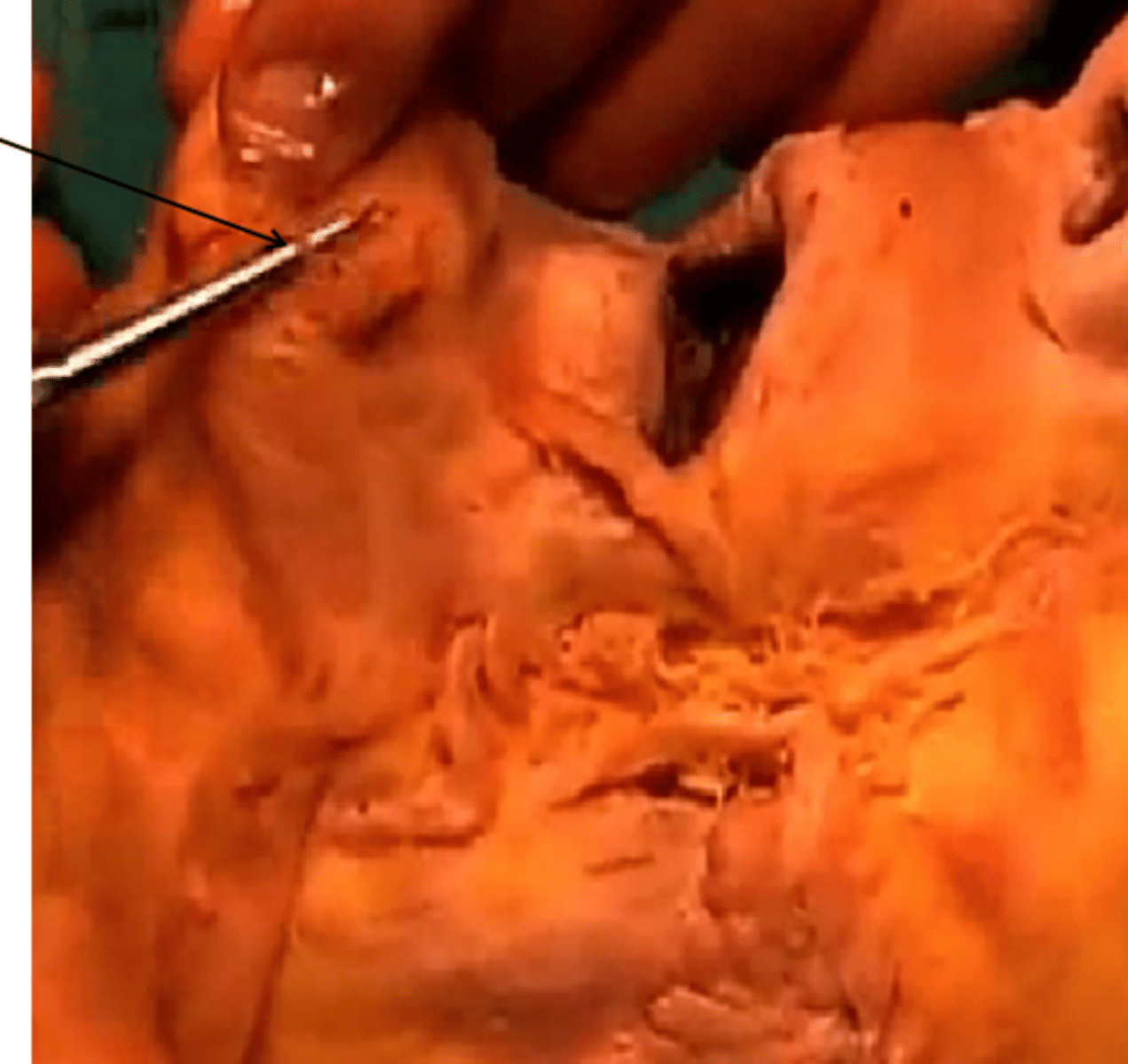 <p>mental nerve on top of probe found after locating the mental foramen</p>
