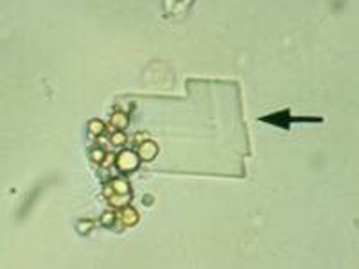 <p>abnormal, rectangular plates with notched corners, nephrotic syndrome</p>
