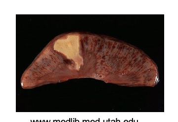 <p>Coagulative necrosis (Form of Necrosis)</p>