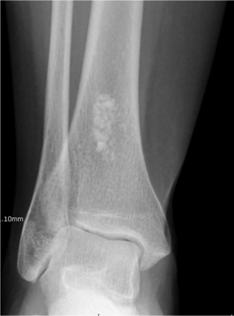 <p>State the radiographic features of solitary enchondroma</p>