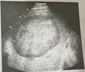 <p>A 66 year old man undergoes a sonographic guided bx of a large liver mass previously discovered on CT. He has a hx of persistent cough, SOB, unexplained wt loss, low-grade fever, and abd. wall discomfort. Two large hyperechoic lesions w/peripheral halos are seen in the rt lobe, the largest measuring 12.6 × 13.2cm. What will the bx confirm?</p>