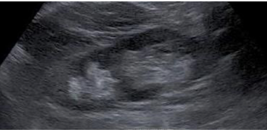 <p>What anatomical variant is shown below?&nbsp;</p>