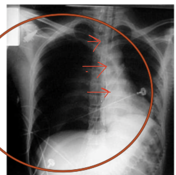 <p>Diagnostics for tension pneumo?</p>