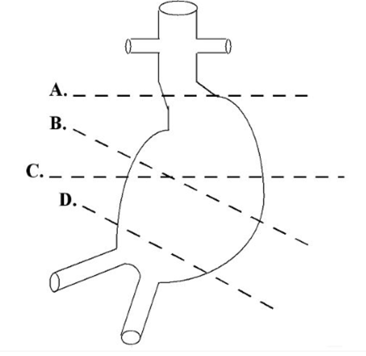 <p>Which of the following shows the correct plane for measuring the diameter of this aortic aneurysm?</p><p>a. a</p><p>b. b</p><p>c. c</p><p>d. d</p><p>e. both b and c are correct</p>