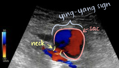 <p>color appearance of <u>“yin-yang” sign</u> in sac (indicates pseudoaneurysm)</p>