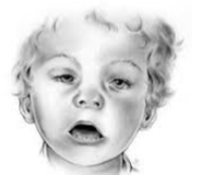 <p>FAS (Fetal Alcohol Syndrome) Features of FAS: Small, facial deformities, intellectual disorder</p>