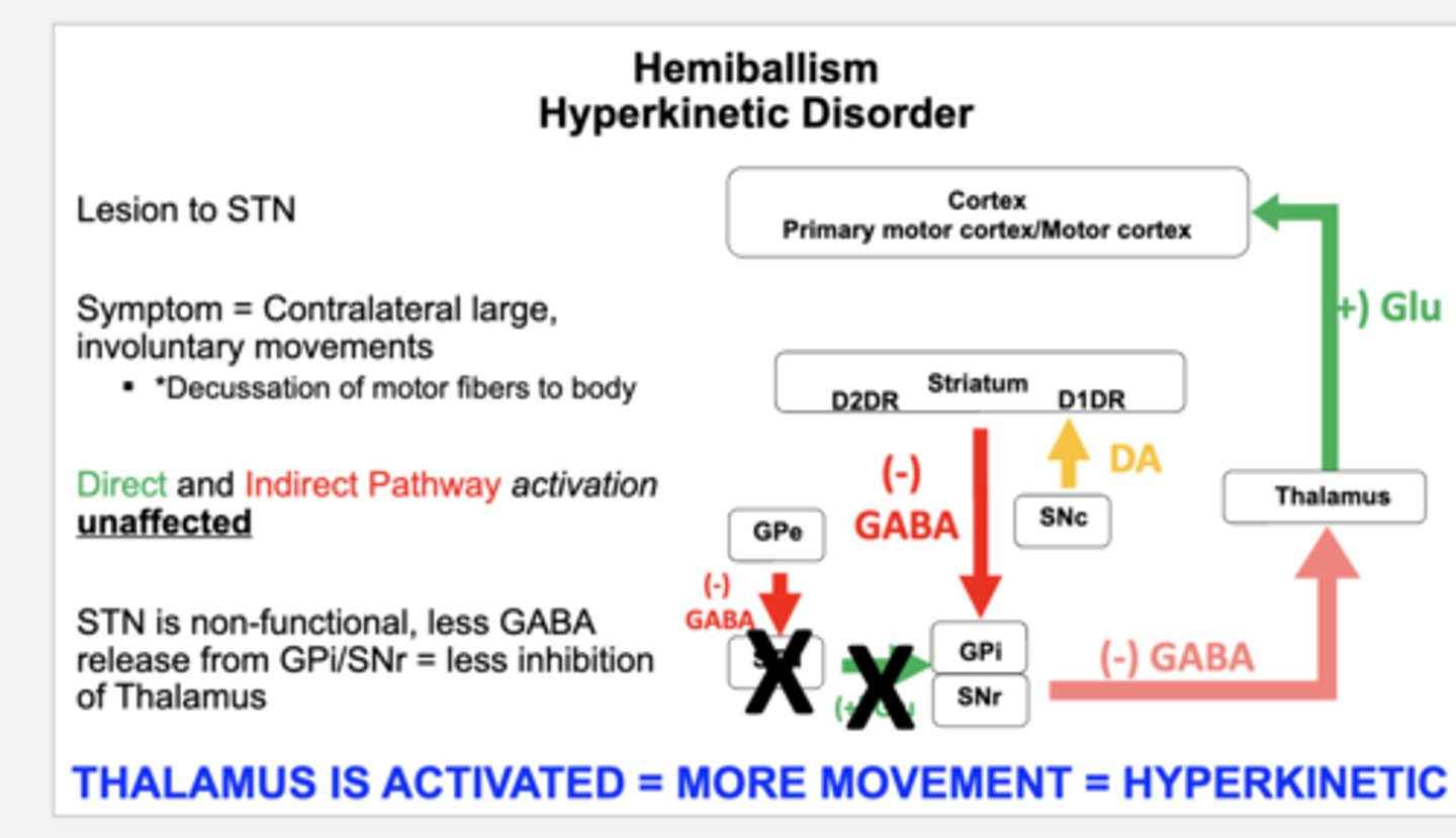 <p>uncontrolled involuntary flinging of limbs on the side contralateral to STN lesion (less output of GPi, cant inhibit unwanted movements)</p>