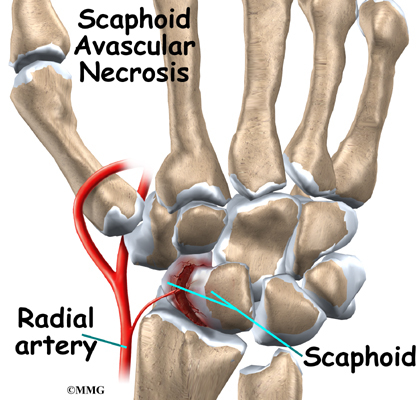 <p>-Broken scaphoid carpal bone</p><p>-may become necrotic</p>