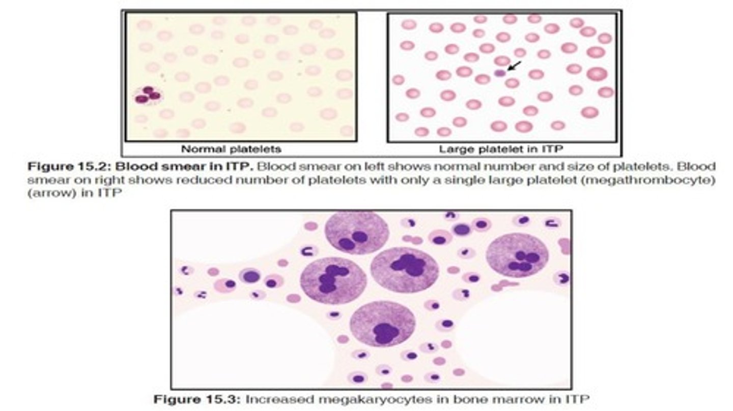 <p>Bone marrow fails to produce sufficient blood cells.</p>