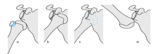 <p>Schultergelenkluxation</p>