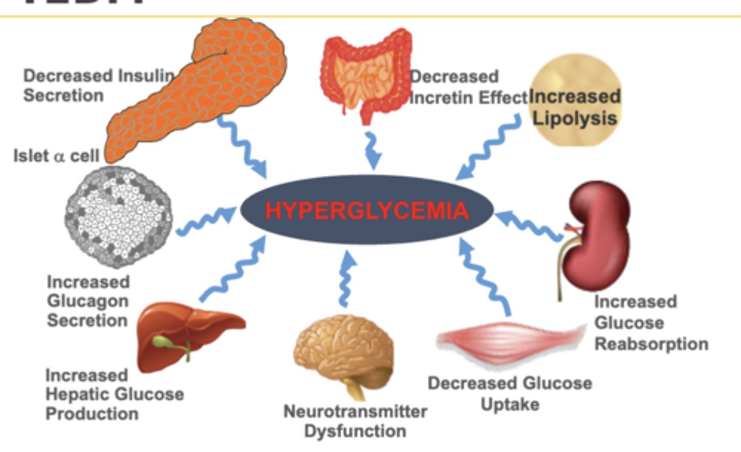 <p>1. Decreased insulin secretion</p><p>o Decreased sensitivity and years of resistance</p><p>2. Increased glucagon secretion</p><p>o Increased gluconeogenesis → hyperglycemia</p><p>3. Increased hepatic glucose production</p><p>o Liver makes glucose at night when fasting die to inability to detect glucose</p><p>4. Neurotransmitter dysfunction</p><p>o Either never satisfied or always satiated</p><p>5. Decrease glucose uptake</p><p>o Increase glucose in blood → hyperglycemia</p><p>6. Increase glucose reabsorption</p><p>7. Increase lipolysis</p><p>8. Decreased incretin effects</p>