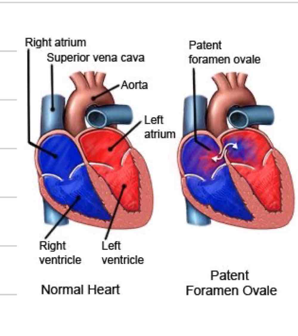 <ul><li><p>Opening between R and L atrium</p></li><li><p>Some blood still flows from R atrium to ventricle and out pulmonary artery</p></li></ul>