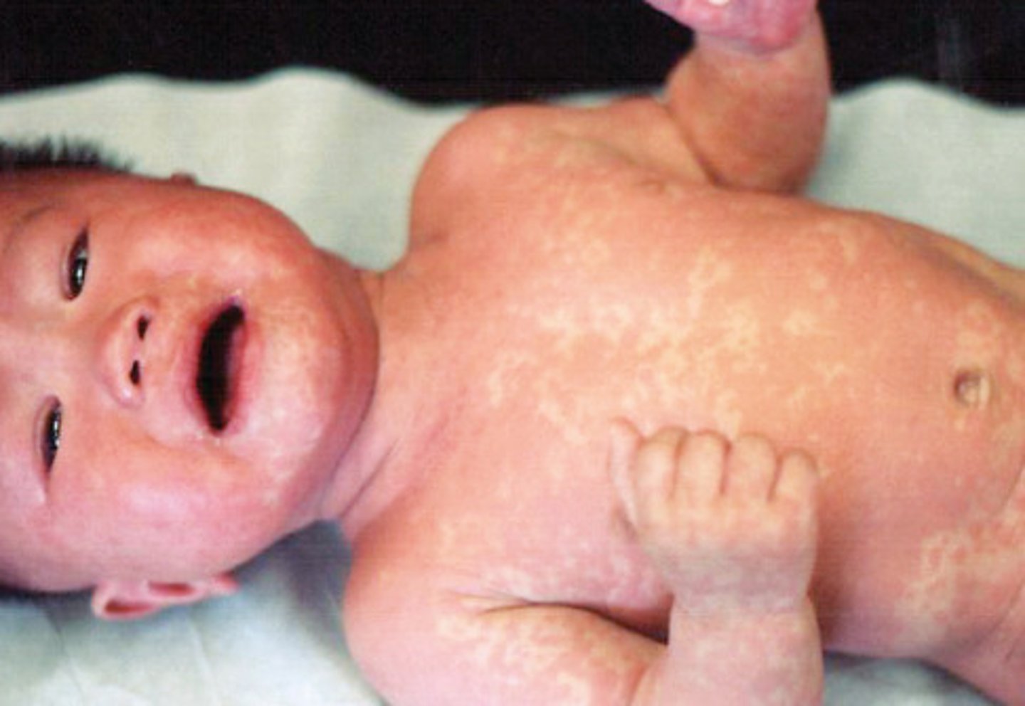 <p>Exanthem subitum/ Sixth disease- high fever suddenly appears which can cause seizures, rash appears after fever goes away, starts on the neck and trunk</p>
