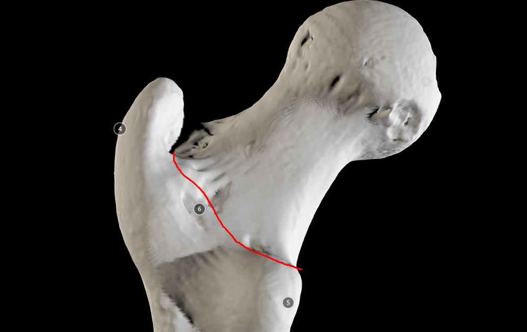 <p>intertrochanteric line - boundary of between tranchanters and neck</p>