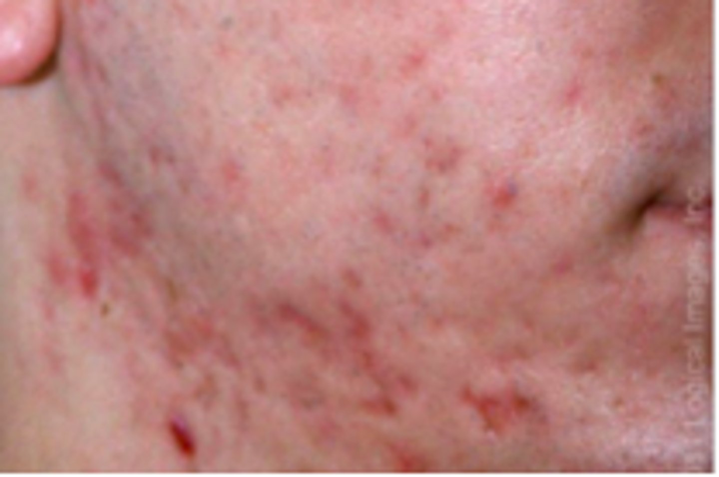 <p>Acneiform Disorders:</p><p>more often result of inflammatory acne than noninflammatory</p>