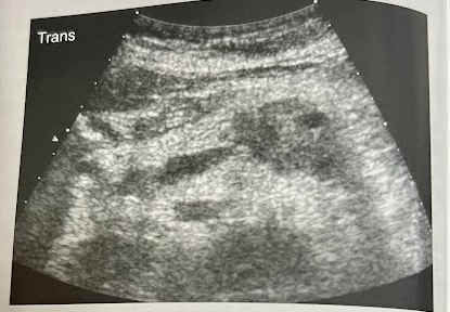 <p>A 75 year old man is referred for an abd. sonogram to r/o gallstones and biliary disease. He reports recent significant wt. loss and epigastric pain. Sonogram reveals findings in this image. What is the most likely diagnosis? </p>