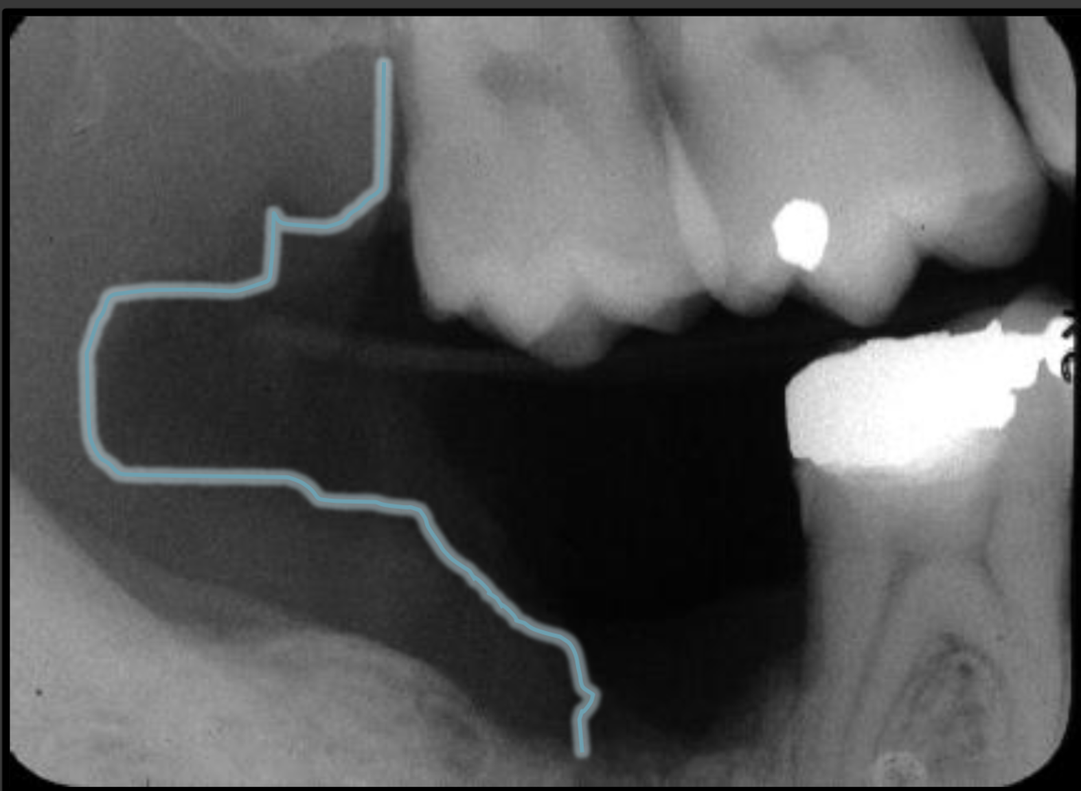 <p>This is a very light radio opacity that is present behind the molars.</p>