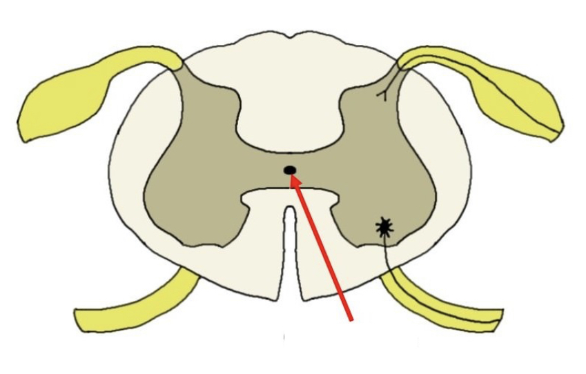 hollow space within the spinal cord that is the remnant of the center of the neural tube