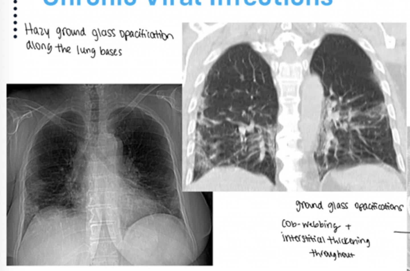 <p>This patient was immunocompromised, got COVID-19, and never received any treatment</p>