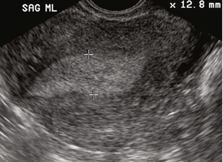 <p> in normal PMB patient, if endometrium is greater than 5mm or appears irregular, what may be needed?</p>