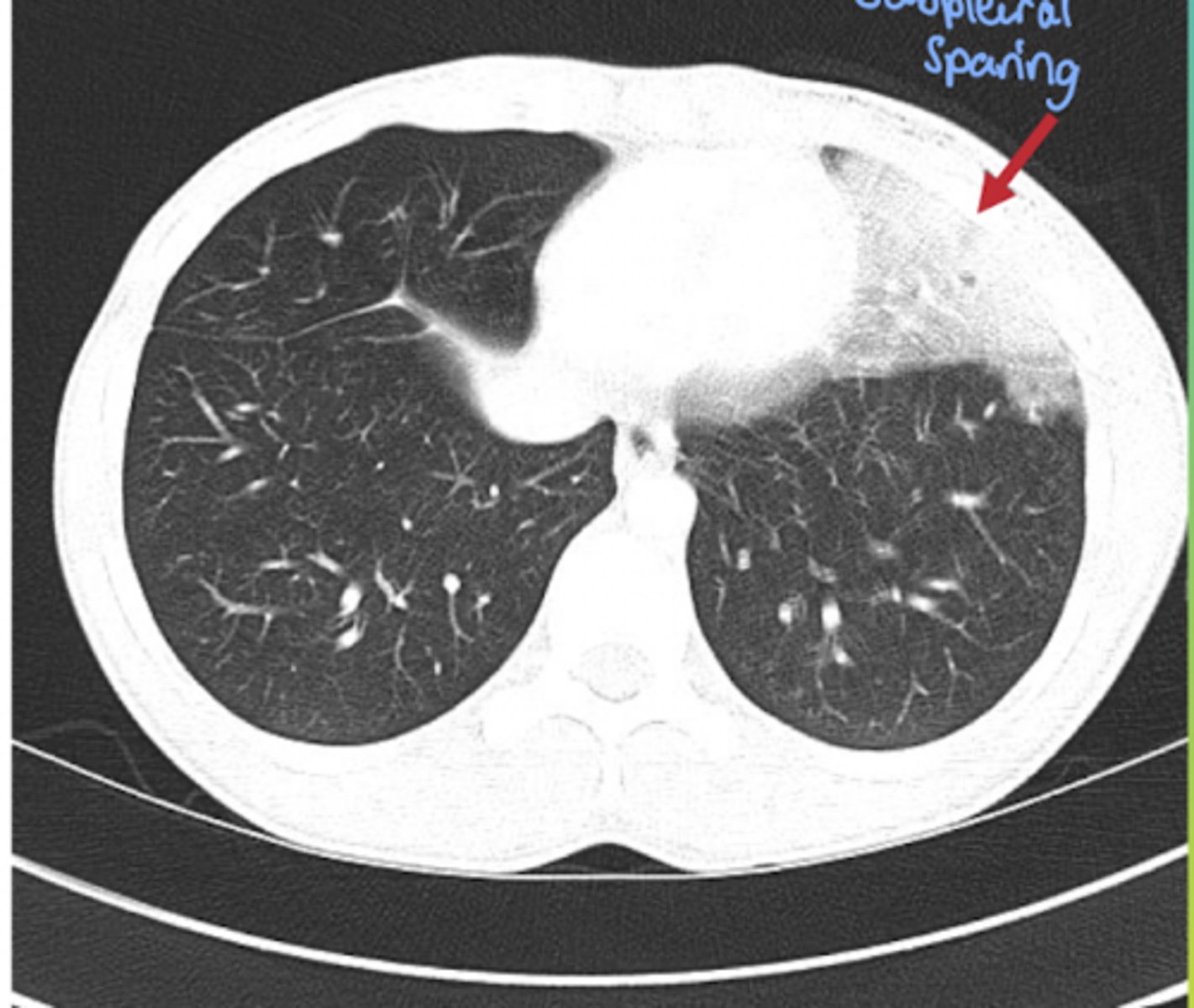 <p>Name the condition (pt has hx of trauma to chest)</p>