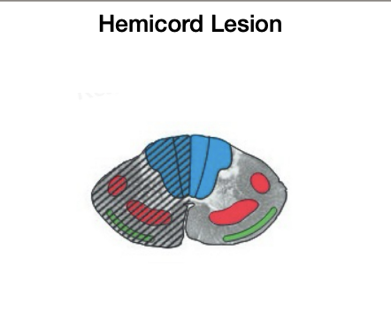 <ul><li><p>SAME SIDE loss of proprioception, light touch, and vibration + motor</p></li><li><p> OPPOSITE SIDE loss of pain, temp, crude touch</p></li></ul><p></p>
