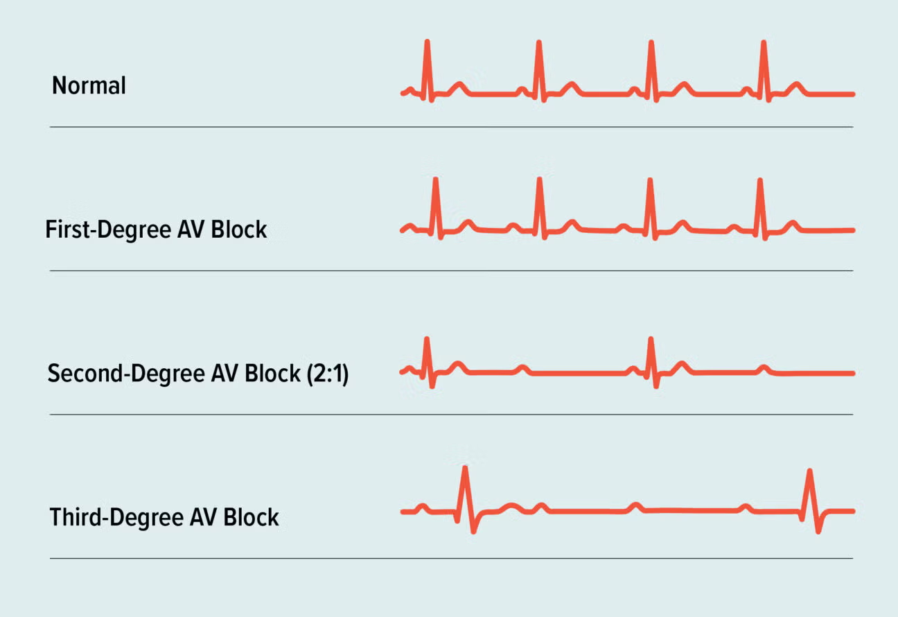 <p>delay or blockage in conduction system</p>