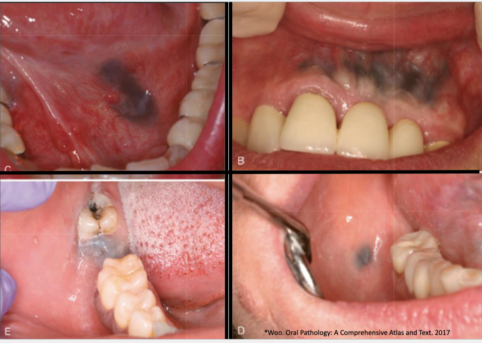 <ol><li><p>gingiva/alveolar ridge mucosa (50%)</p></li><li><p>buccal mucosa </p></li><li><p>floor of mouth </p></li></ol><p></p>