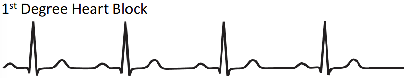 <ul><li><p>long time between P wave and QRS</p></li><li><p>aka 1st degree AV block</p></li><li><p>AVN takes longer to produce ventricular depolarisation</p></li><li><p>always QRS after p wave</p></li></ul><p></p>