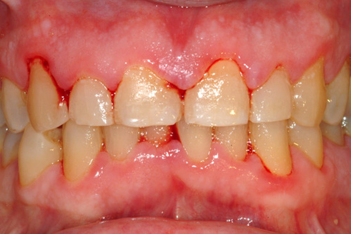 <p>Stage II, bleeding will occur</p>