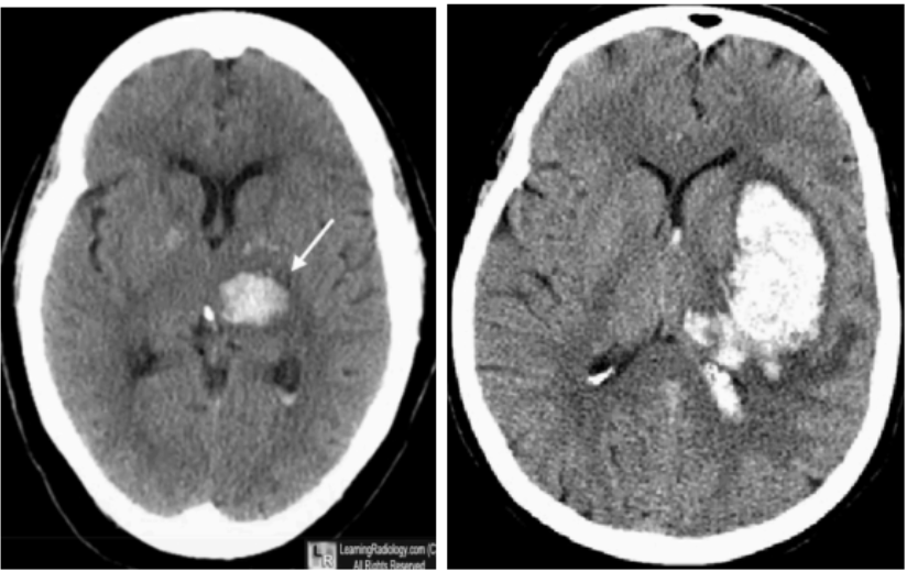 <p>Hemorrhagic Stroke</p>