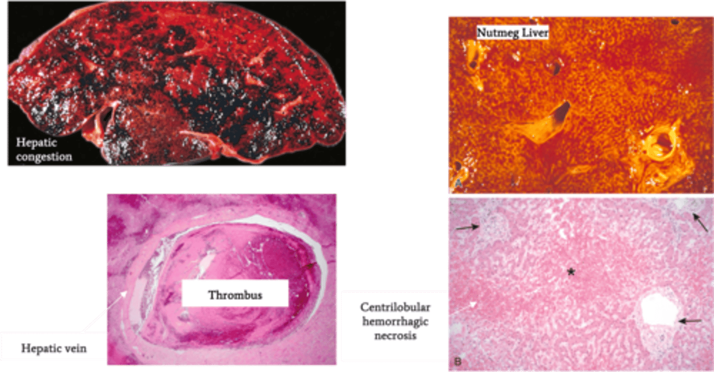 <p>Define Condition:</p><p>Hepatic venous outflow obstruction d/t thrombosis OR compression of hepatic vein; POST-HEPATIC</p><p>-Hx: Hypercoagulable States</p><p>&gt; Polycythemia Vera</p><p>&gt; HCC</p><p>&gt; OCP</p><p>&gt; Pregnancy</p><p>-Path:</p><p>-Sx/PE:</p><p>&gt; Abd Pain</p><p>&gt; Ascites</p><p>&gt; Hepatomegaly</p><p>-Dx:</p><p>&gt; Gross:</p><p>&gt;&gt; Hepatic Congestion</p><p>&gt;&gt; Hepatomegaly</p><p>&gt;&gt; Tense Capsule</p><p>&gt; Biopsy:</p><p>&gt;&gt; Severe Centrilobular congestion and necrosis</p><p>&gt;&gt; Passive Liver Congestion = NUTMEG LIVER</p><p>&gt;&gt; Major veins may have thrombi</p>