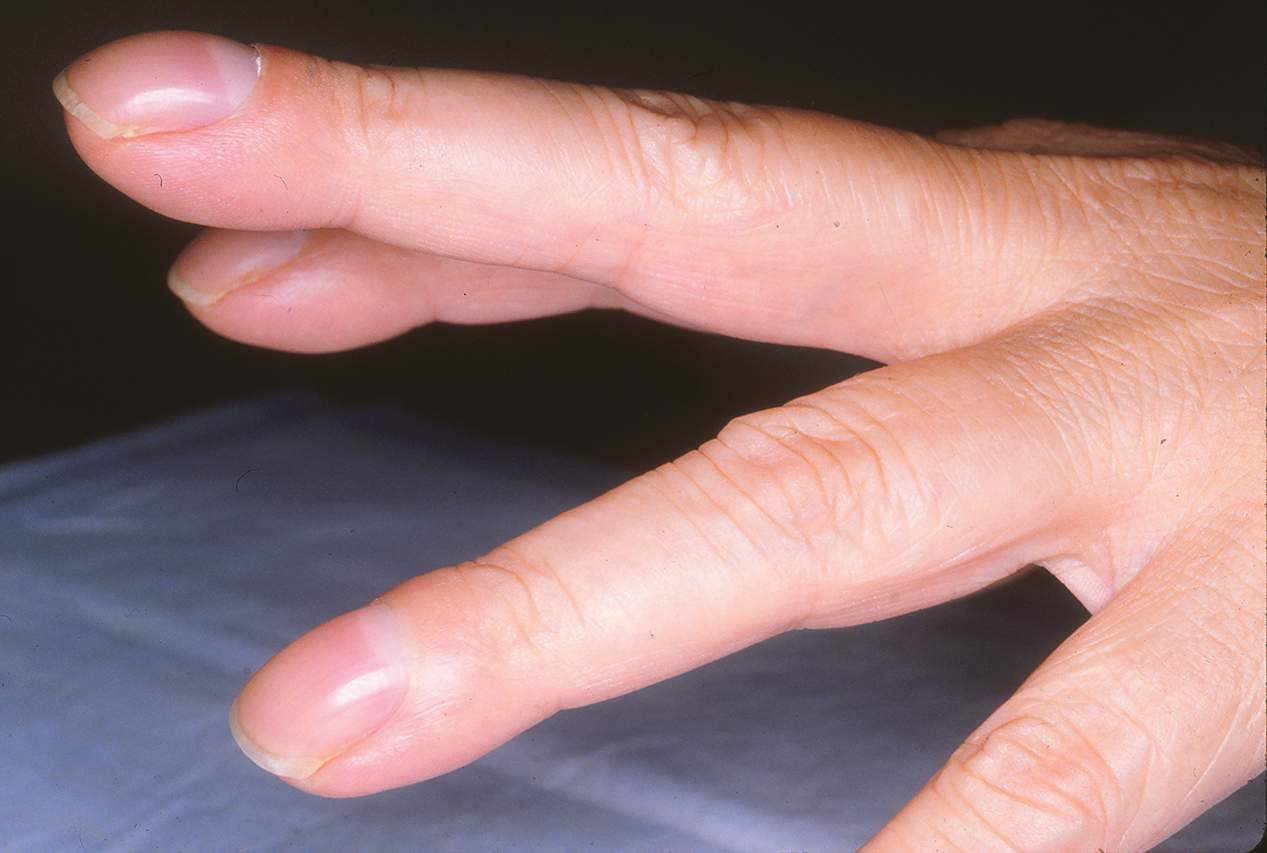 <ul><li><p><span><strong>loss of normal hyponychial angle</strong>: </span></p><ul><li><p><span>the angle between the nail bed and the cuticle increases and rounds out</span></p></li><li><p>nails curve downwards</p></li></ul></li><li><p><span><strong>Schamroth’s sign:</strong></span></p><ul><li><p>Ask the patient to place the dorsal surfaces of the terminal phalanges of index <strong>back-to-back</strong>.</p></li><li><p><strong>Normal</strong>: A small diamond-shaped window of light is visible between the nails.</p></li><li><p><strong>Positive Schamroth’s Sign</strong>: <strong>No window</strong> — the space is obliterated due to the nails being more convex and the tissues swollen, indicating clubbing.</p></li></ul></li><li><p><span>linked with <strong>cyanotic congenital heart disease</strong></span></p></li></ul><img src="https://knowt-user-attachments.s3.amazonaws.com/4e1f1786-d97b-44f8-9655-21cf6c5fd658.png" data-width="100%" data-align="center"><p></p>