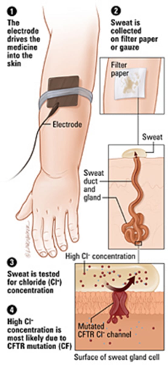 <p>Cystic Fibrosis</p>