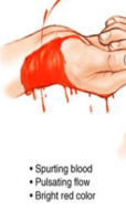 <p>Rapid And Profuse </p><p>Spurting With Heart Beat </p><p>Most Difficult To Control</p>