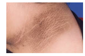 <p>Acanthosis nigricans </p>