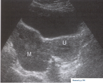 <ul><li><p><strong>MC malignancy in CHILDHOOD </strong></p></li><li><p>high AFP and beta HCG</p></li></ul><p></p>