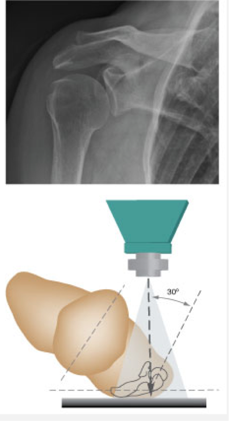 <p>Oblique shoulder</p>