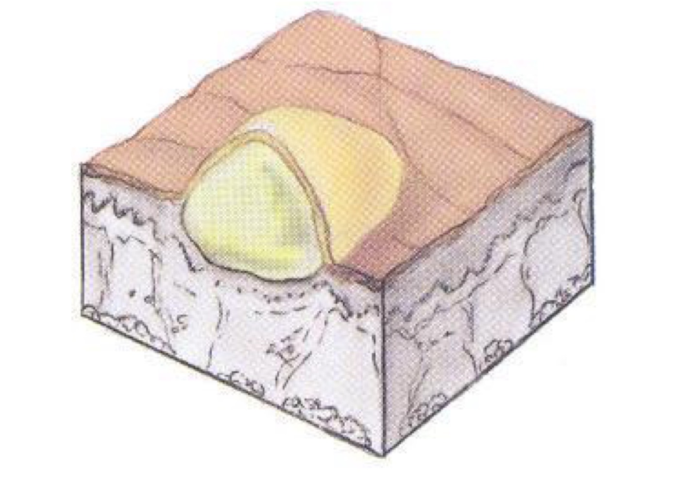 <p>what type of skin lesion is this? </p>