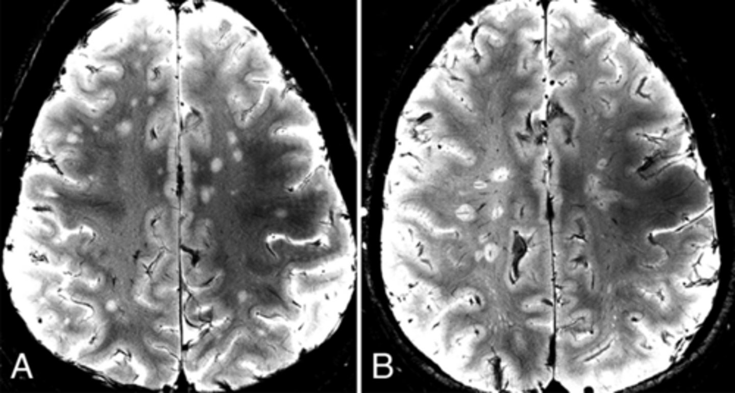 <p>A diagnostic imaging marker where a central vein is visible within a white matter lesion, helping to distinguish MS from other conditions.</p>